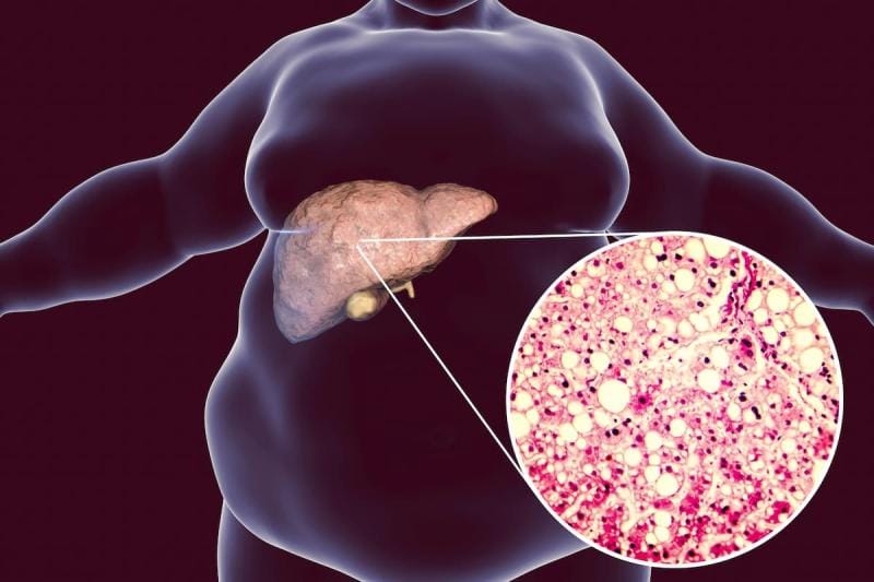 GLP-1 Agonists: Retatrutide mops up fatty liver disease